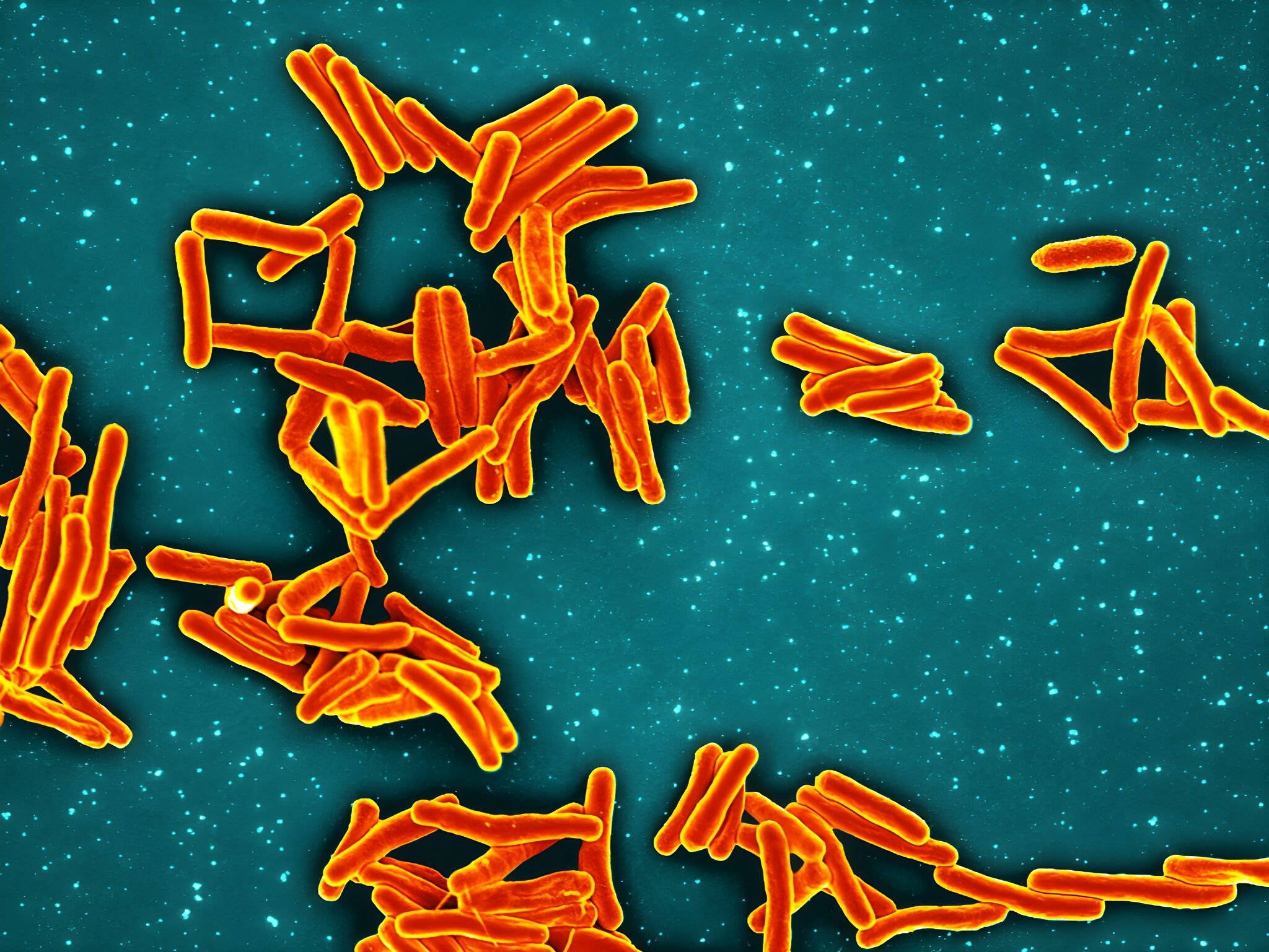 'This is a big outbreak': Nearly 1 in 5 affected by TB at SF school