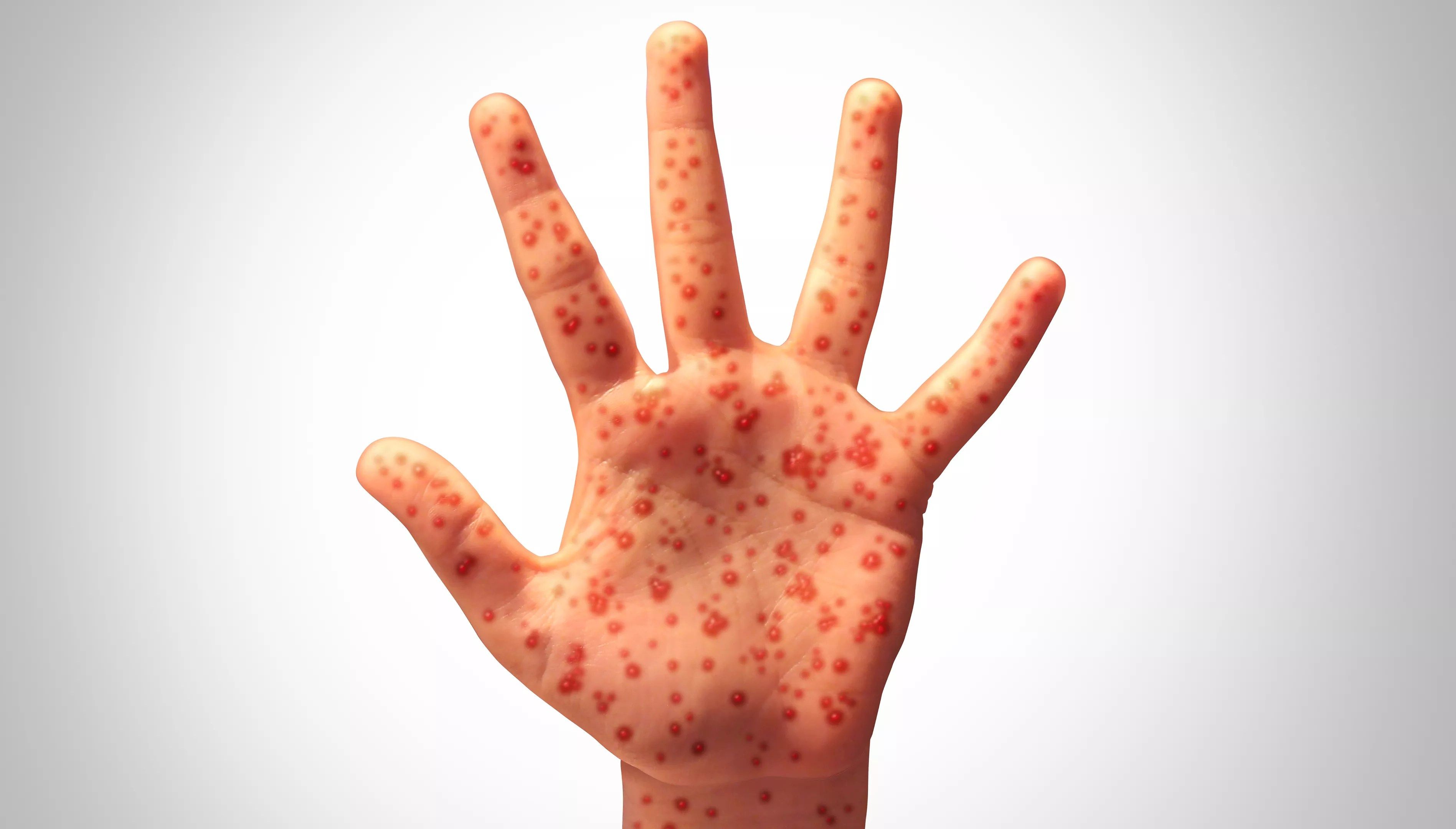 Mesa latest site of growing East Valley measles outbreak